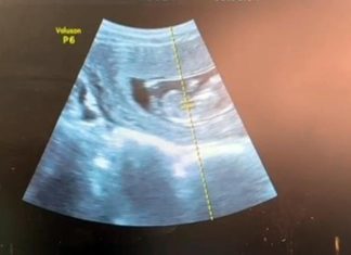 Chist ovarian gigant la o pacientă însărcinată. Intervenție laparoscopică reușită la Spitalul Onești